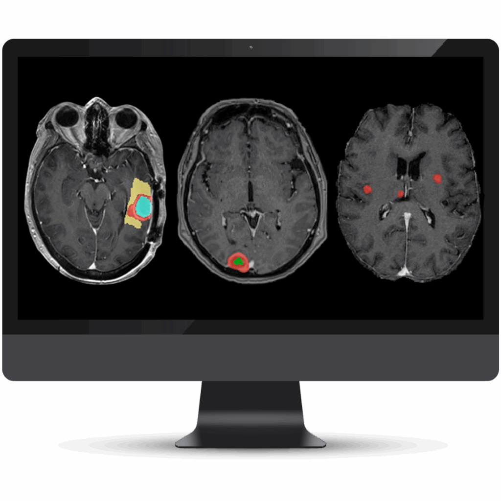 NQ BT Cortechs.ai|NeuroQuant Brain Tumor