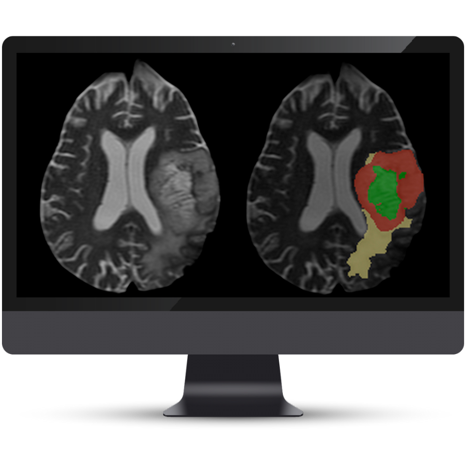 NQ BT 2.0 Gliomas Cortechs.ai|NeuroQuant Brain Tumor