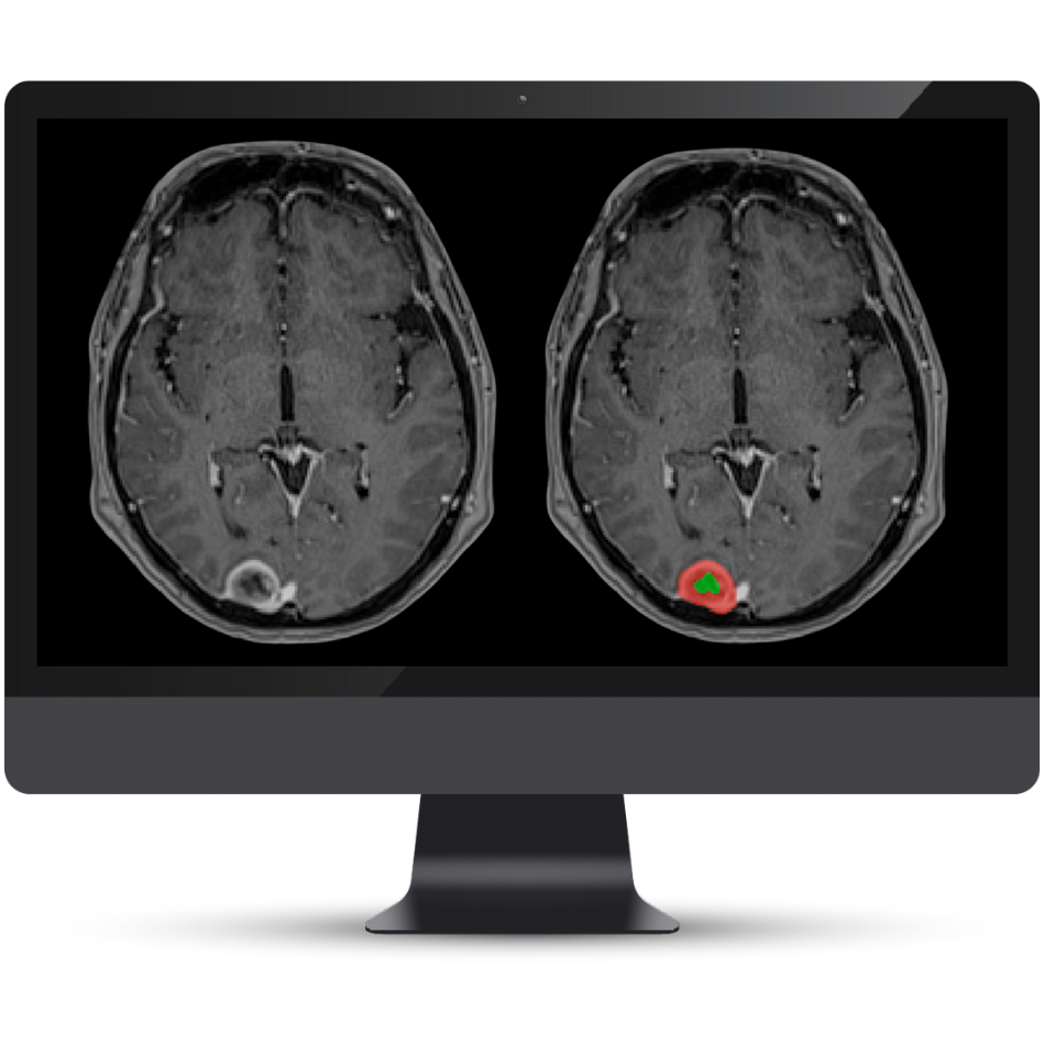 NQ BT 2.0 Menginiomas Cortechs.ai|NeuroQuant Brain Tumor