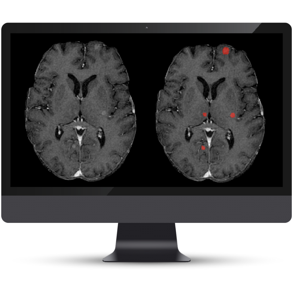 NQ BT 2.0 Mets Cortechs.ai|NeuroQuant Brain Tumor