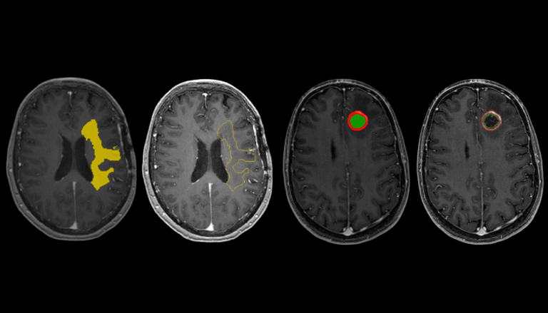 Enhancing Brain Tumor Treatment with RT STRUCT Images: The Promise of ...
