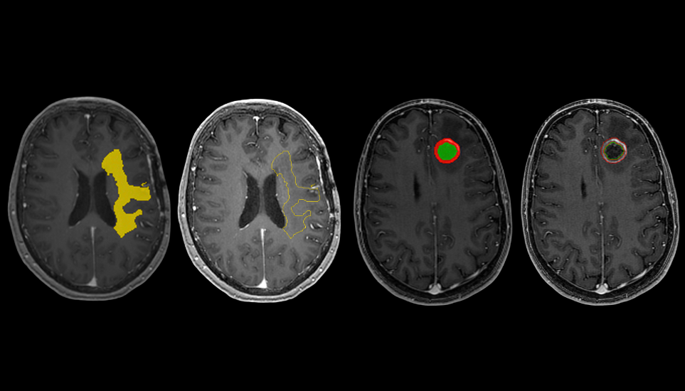Cortechs.ai | Enhancing Brain Tumor Treatment with RT STRUCT Images: The Promise of Automation Cortechs.ai | Enhancing Brain Tumor Treatment with RT STRUCT Images: The Promise of Automation