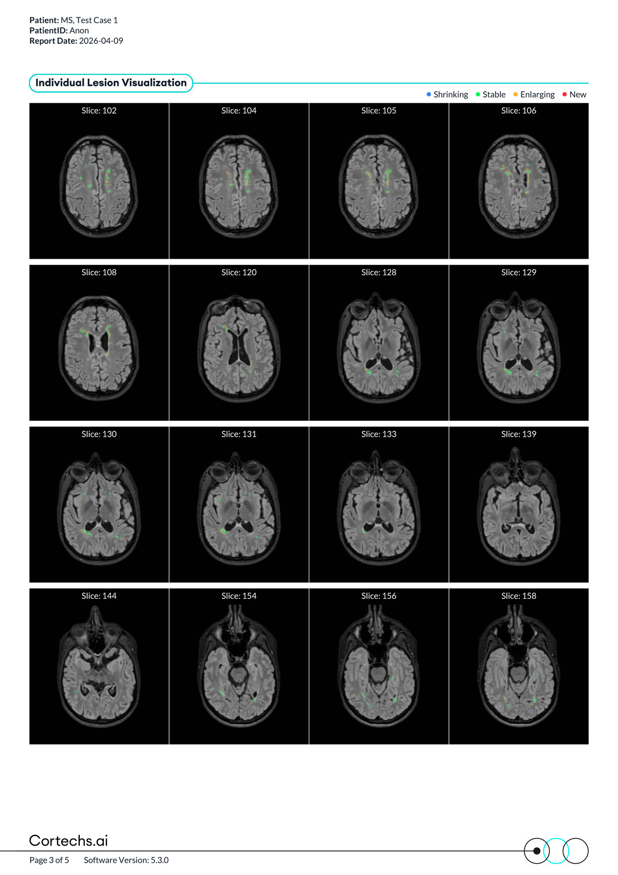 Cortechs.ai|NeuroQuant MS FLAIR Lesion and Atrophy Report PLUS