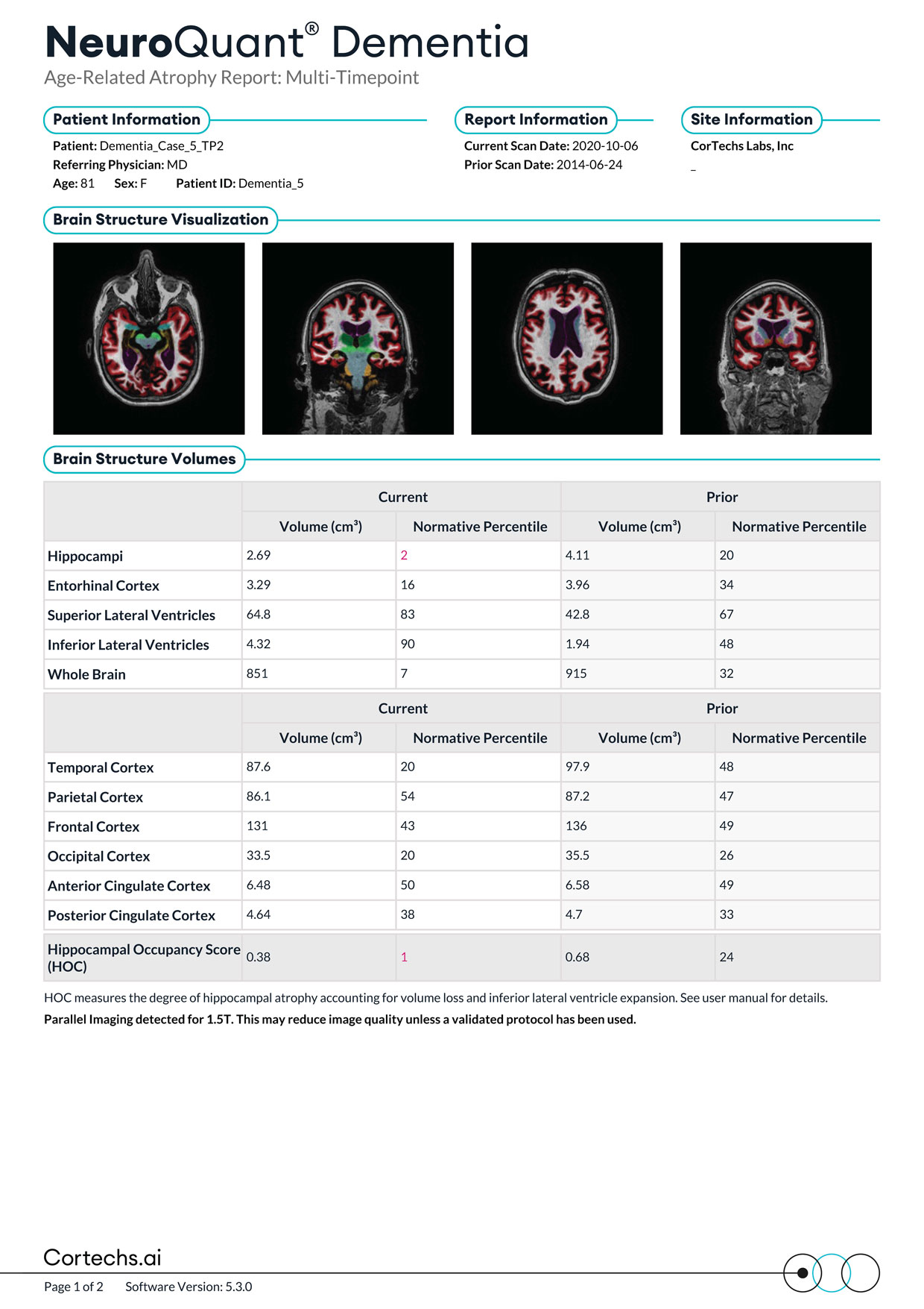 Cortechs.ai|NeuroQuant Dementia Report