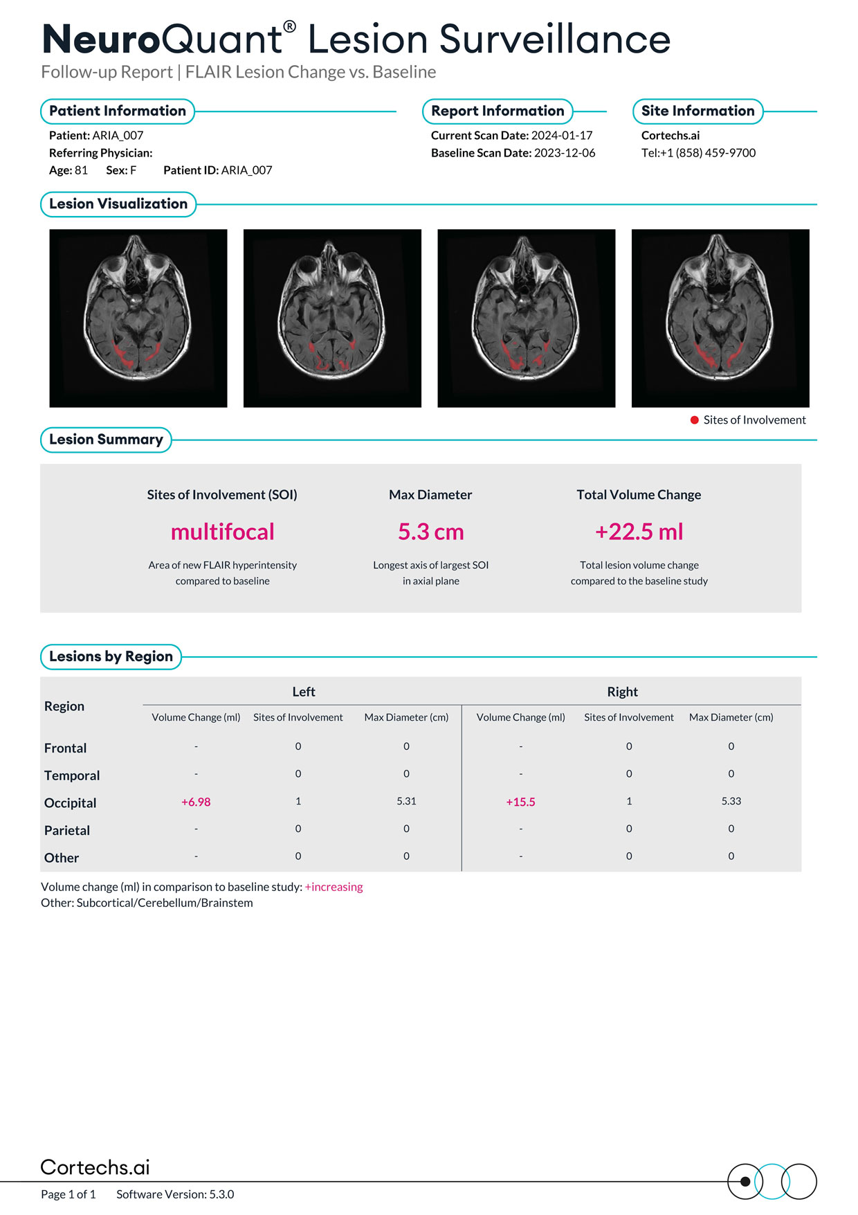 Cortechs.ai|NeuroQuant Lesion Surveillance FLAIR Report