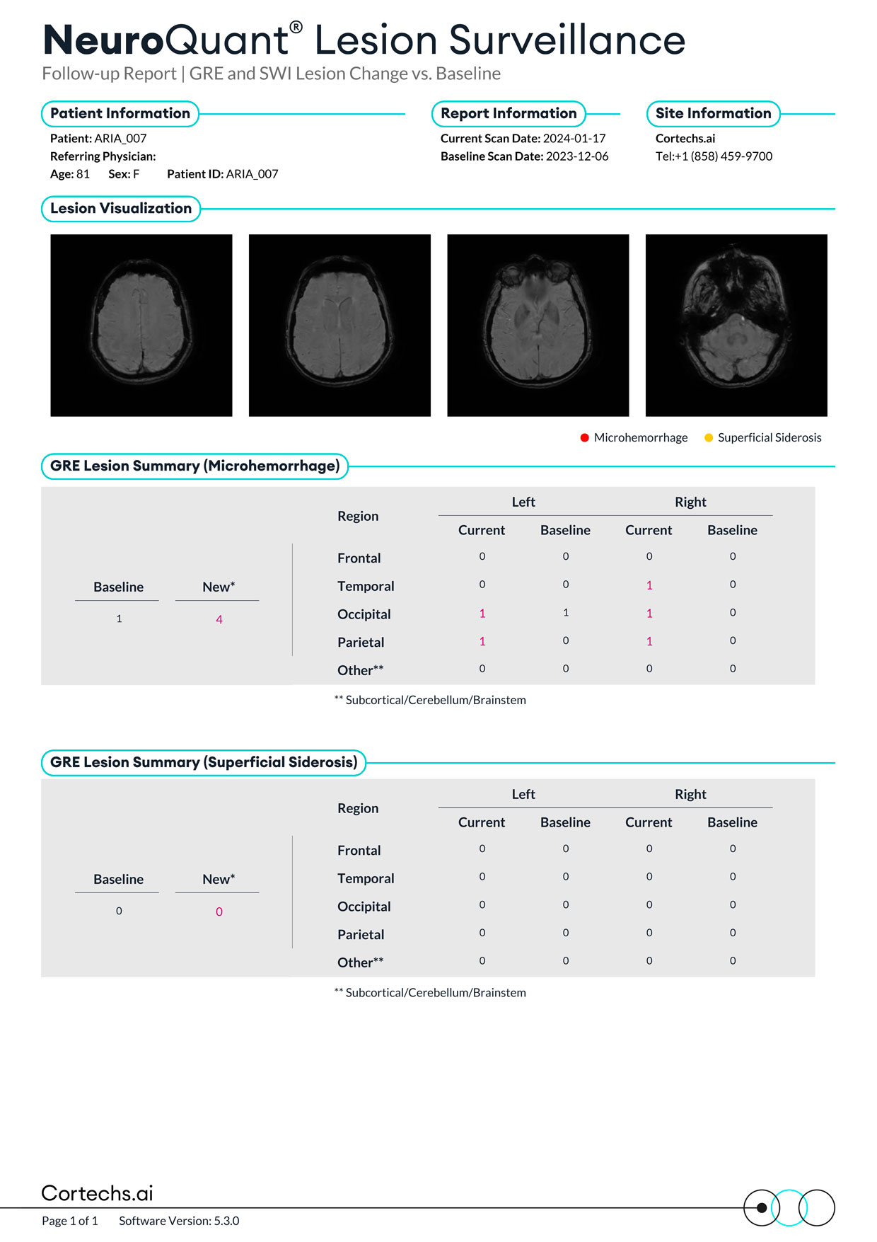 Cortechs.ai|NeuroQuant Lesion Surveillance GRE Report