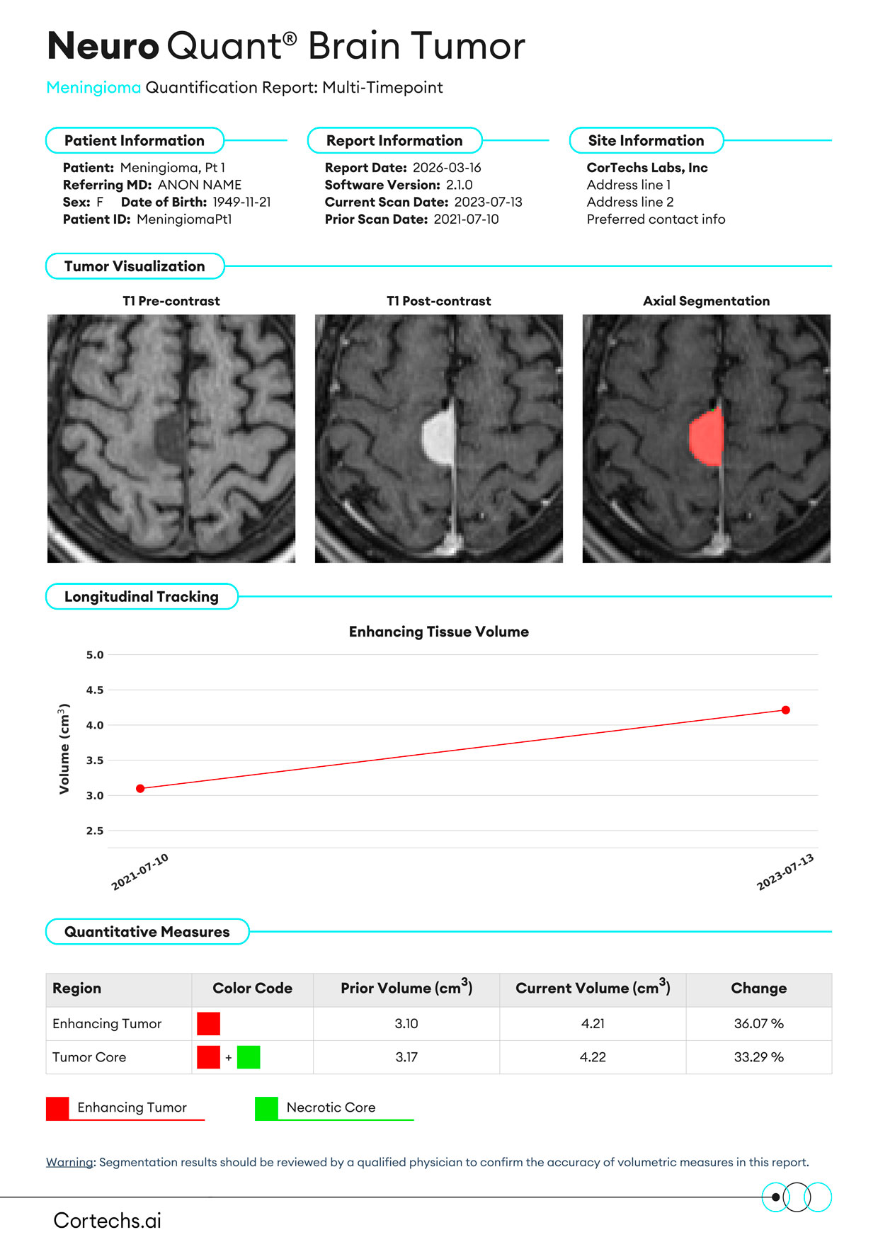 Cortechs.ai|NeuroQuant Brain Tumor Meningioma Report