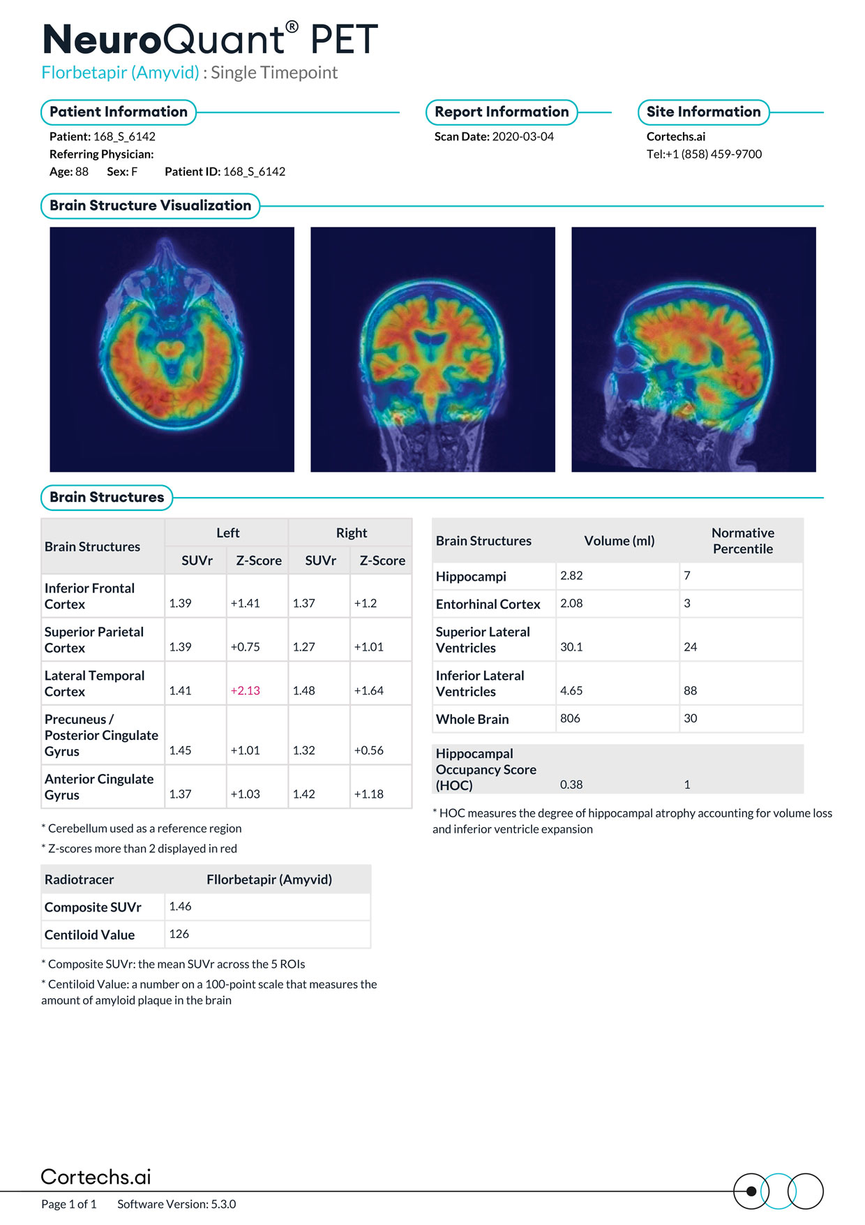 Cortechs.ai|NeuroQuant PET Florbetapir Report