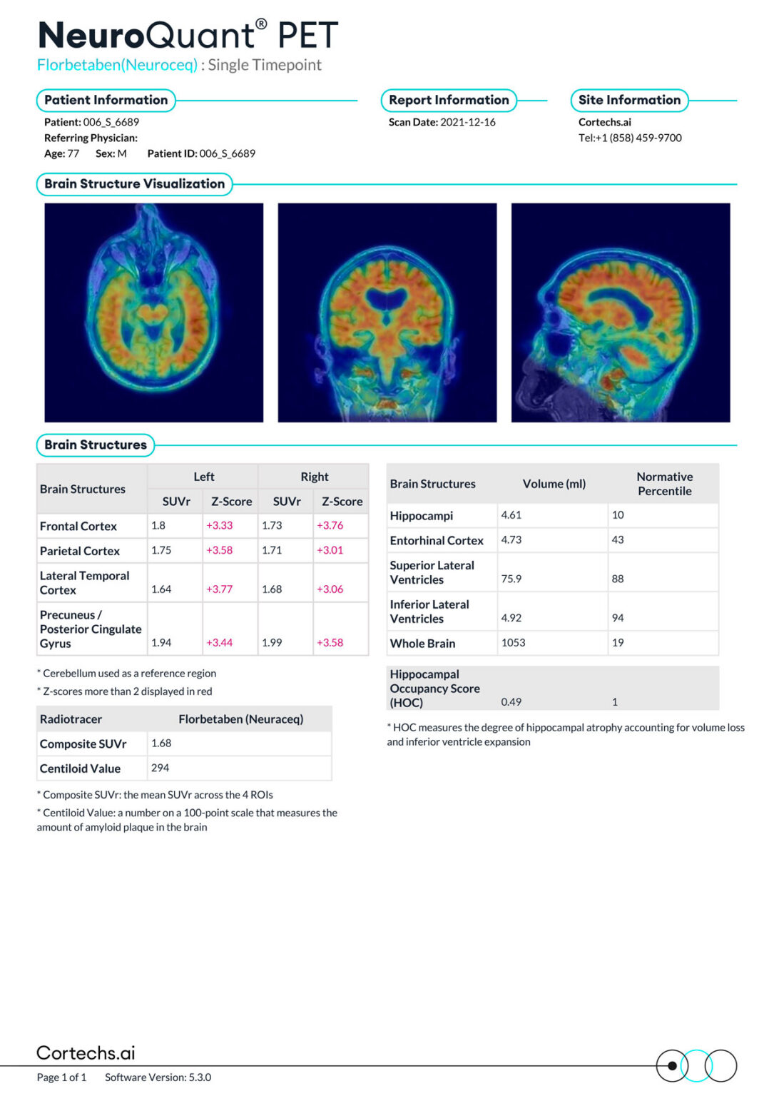 Neurowquant NeuroQuant PET Florbetaben Report - Cortechs.ai