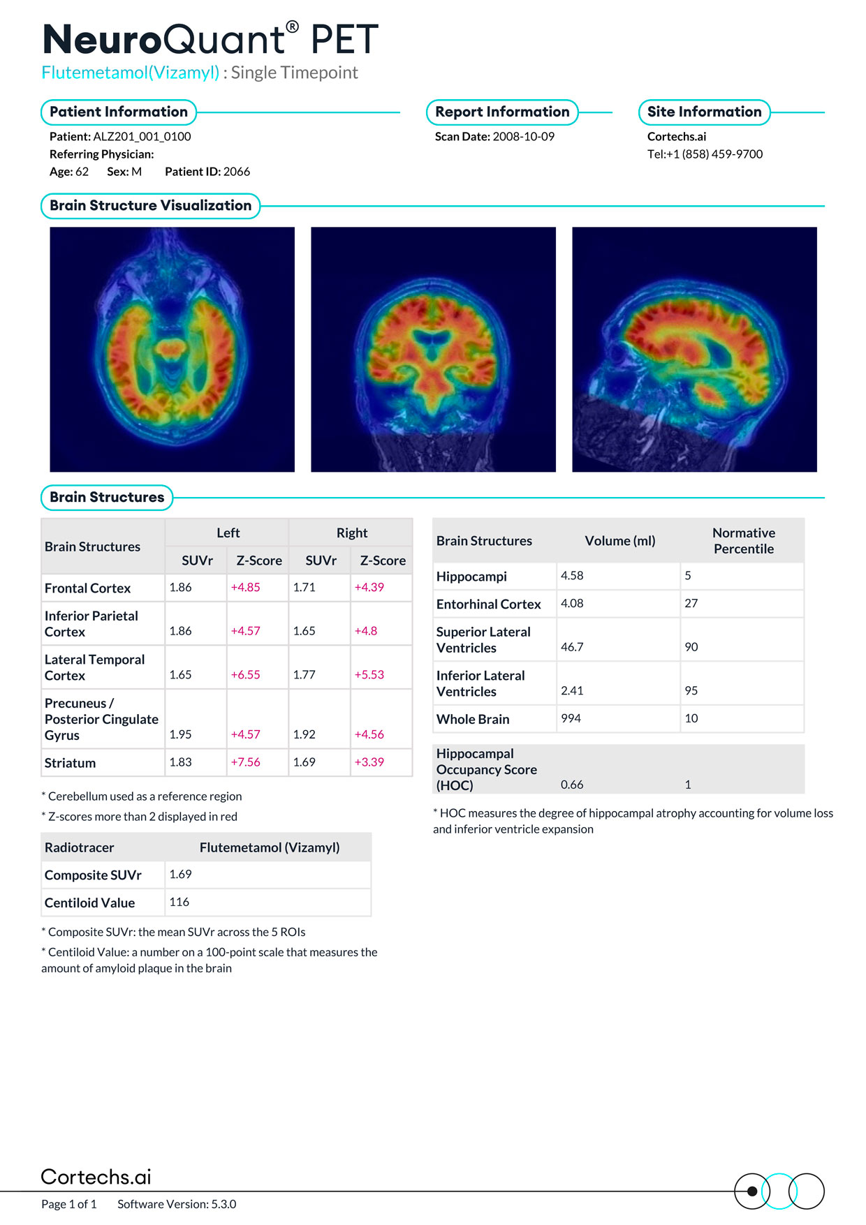 Cortechs.ai|NeuroQuant PET Flutemetamol Report