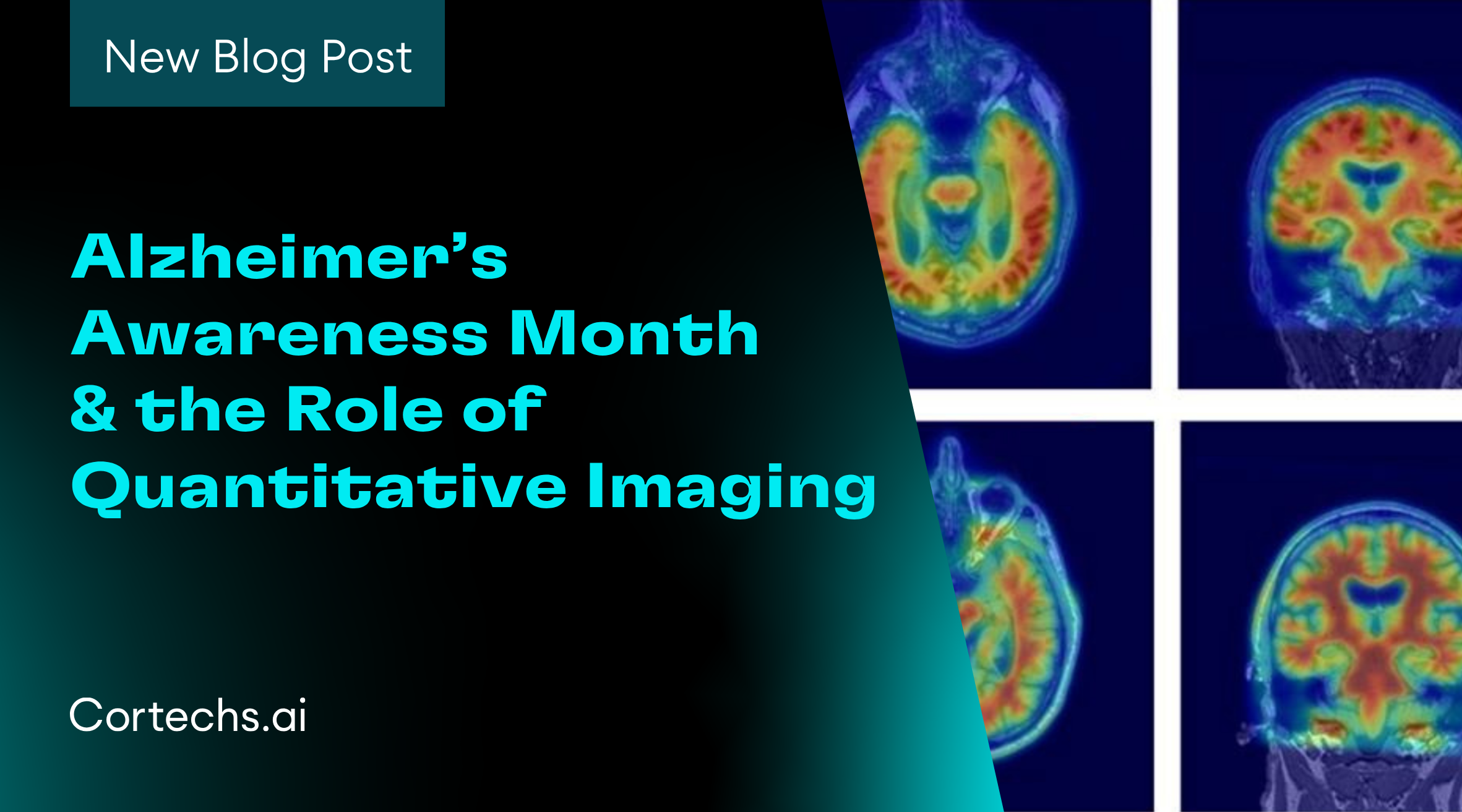 Alzheimer’s Awareness Month & the Role of Quantitative Imaging