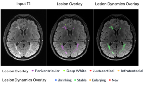 Cortechs.ai | Read Your Segmentations in the Same Space You Read the Study: Native Space Outputs in NeuroQuant v5.3.0 Cortechs.ai | Read Your Segmentations in the Same Space You Read the Study: Native Space Outputs in NeuroQuant v5.3.0