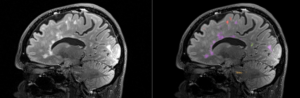 Cortechs.ai | Read Your Segmentations in the Same Space You Read the Study: Native Space Outputs in NeuroQuant v5.3.0 Cortechs.ai | Read Your Segmentations in the Same Space You Read the Study: Native Space Outputs in NeuroQuant v5.3.0