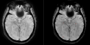 Cortechs.ai | Read Your Segmentations in the Same Space You Read the Study: Native Space Outputs in NeuroQuant v5.3.0 Cortechs.ai | Read Your Segmentations in the Same Space You Read the Study: Native Space Outputs in NeuroQuant v5.3.0