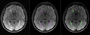 Cortechs.ai | Read Your Segmentations in the Same Space You Read the Study: Native Space Outputs in NeuroQuant v5.3.0 Cortechs.ai | Read Your Segmentations in the Same Space You Read the Study: Native Space Outputs in NeuroQuant v5.3.0