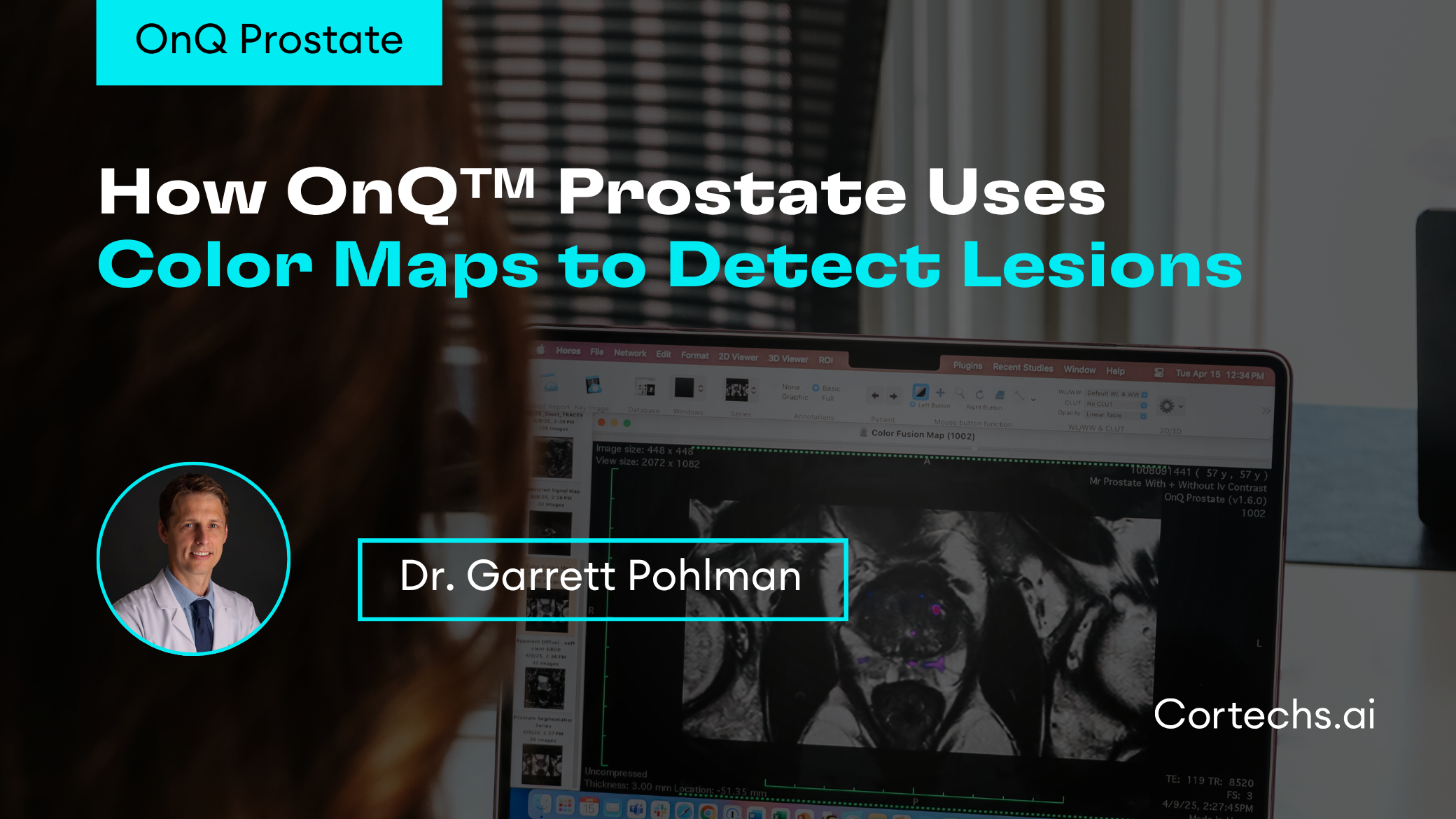 Cortechs.ai | RSNA 2023: AI in Alzheimer’s Disease – From Early Detection to ARIA